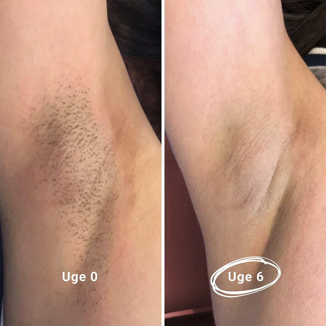 IPL - Permanente hårfjerninger