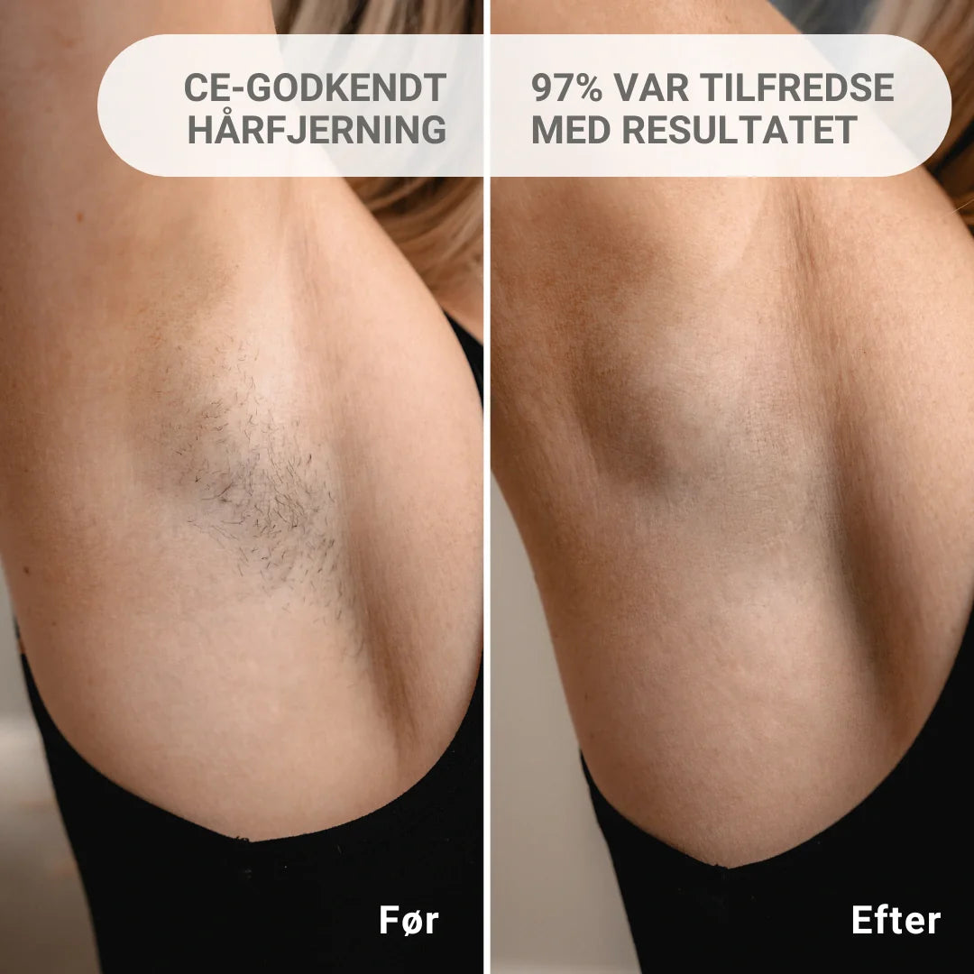 IPL - Permanente hårfjerninger